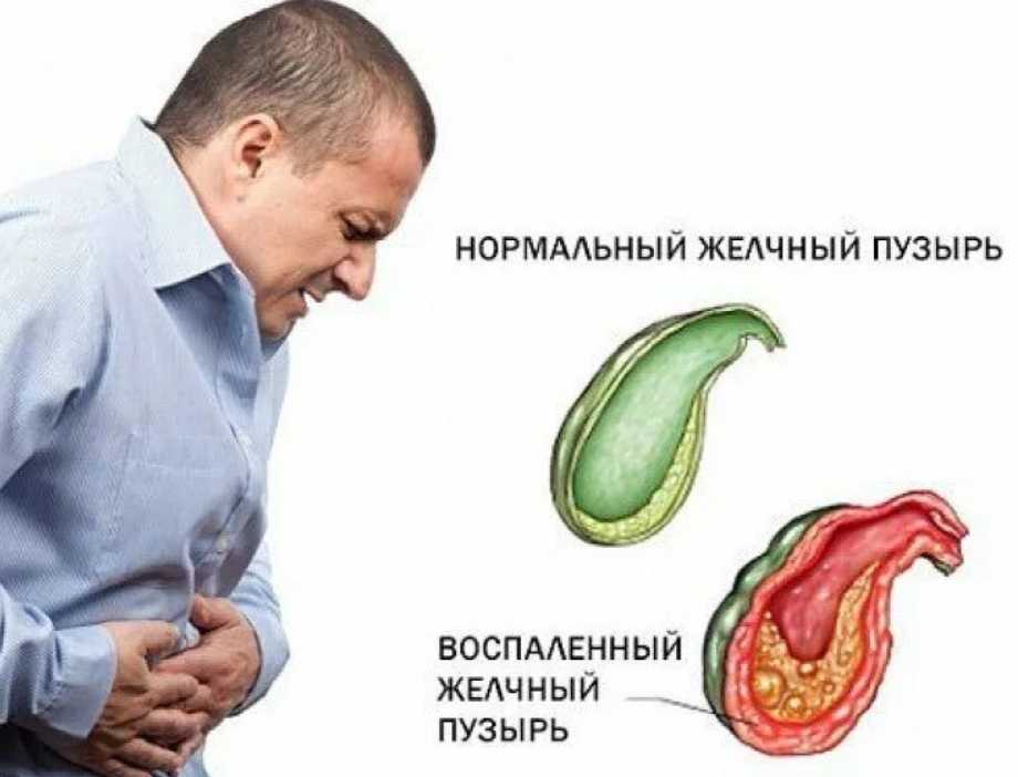 Желчный пузырь: песок, густая желчь, взвесь, рыхлый осадок в желчном пузыре (билиарный сладж) - медицинский центр «эхинацея»