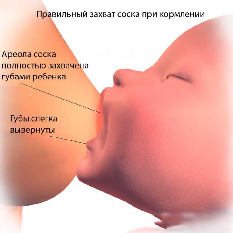 Набухшие молочные железы у новорожденных: причины и лечение
