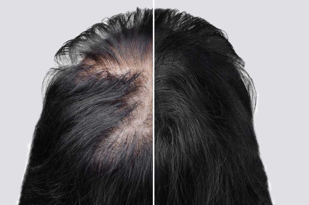Сильное выпадение волос у женщин: причины, лечение, что делать, к кому обратиться, как остановить сильное выпадение?