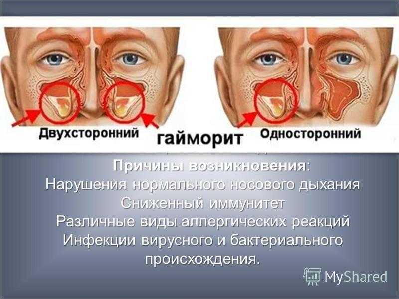 Частая заложенность носа. Гайморит симптоматика. Хронический гайморит симптомы.