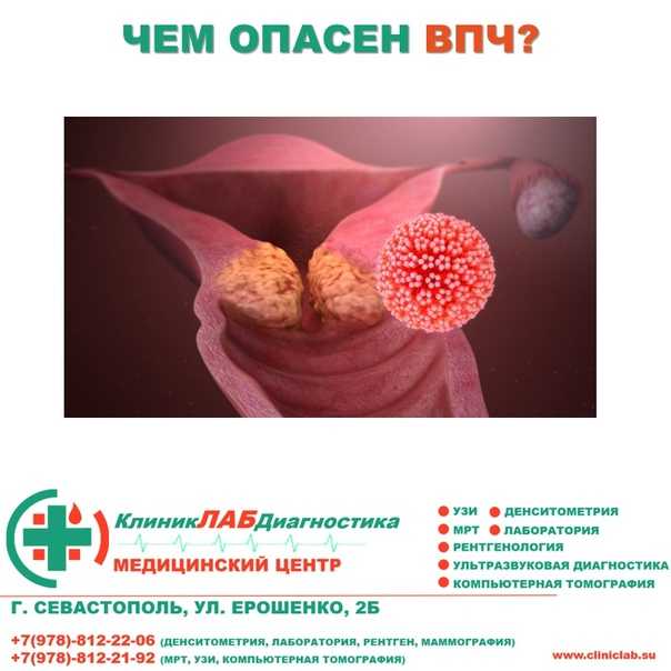 Бактериальный вагиноз у женщин с папилломавирусной инфекцией гениталий