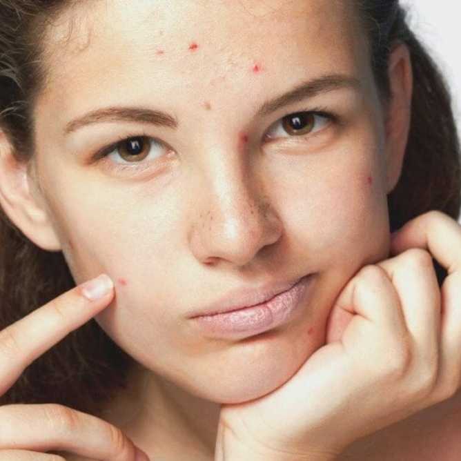 Уход за проблемной кожей лица: советы от экспертов