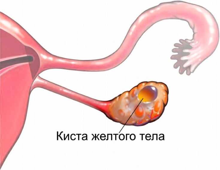 Желтая киста при беременности формируется вместо желтого тела, развивающегося в яичнике после овуляции.