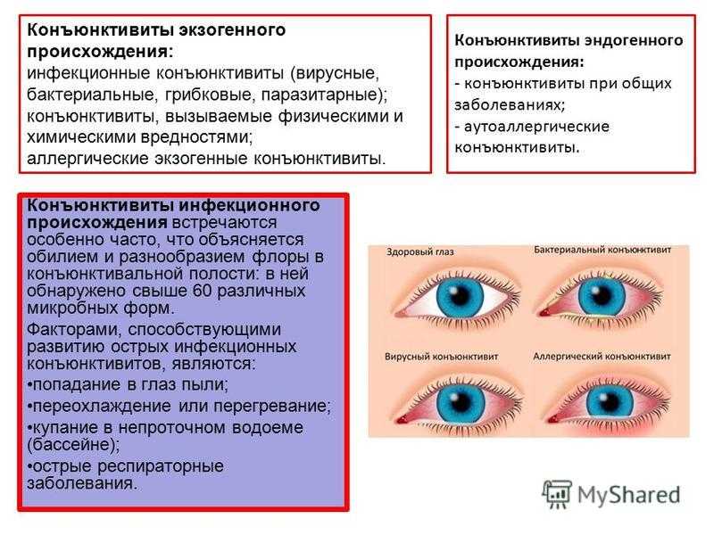 Блефарит - виды, признаки, лечение заболевания глаз