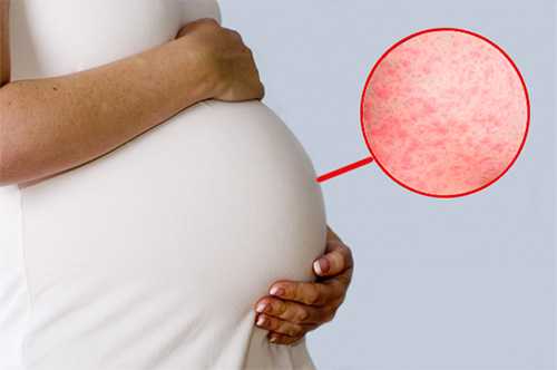Почему появляется сыпь на животе при беременности и как ее лечить?