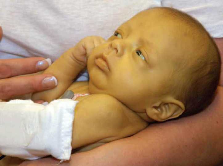 Механическая желтуха ─ одна из разновидностей желтух у новорожденных