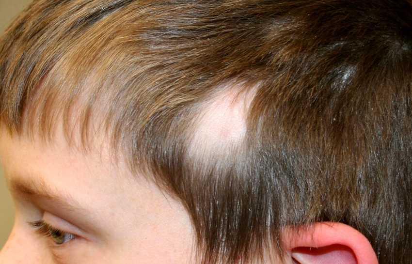 Психоэмоциональные нарушения у пациентов с выпадением волос :: врачам-специалистам