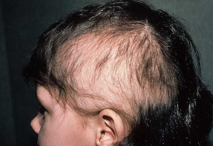 При каких заболеваниях происходит выпадение волос? заболевания вызывающие выпадение волос - советы трихолога