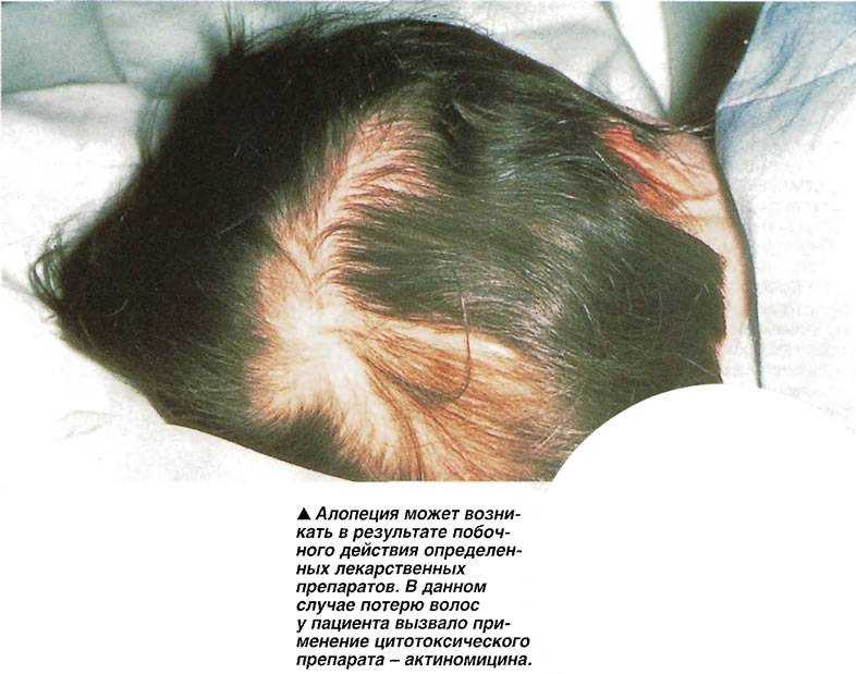 Лечение выпадения волос у женщин после 30