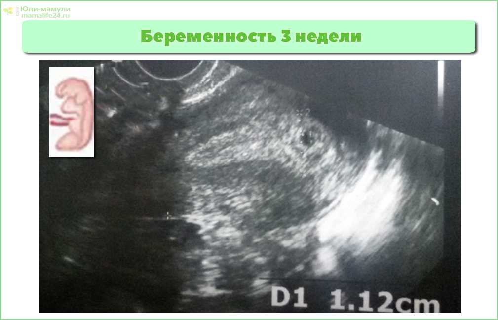 7-8 недель беременности