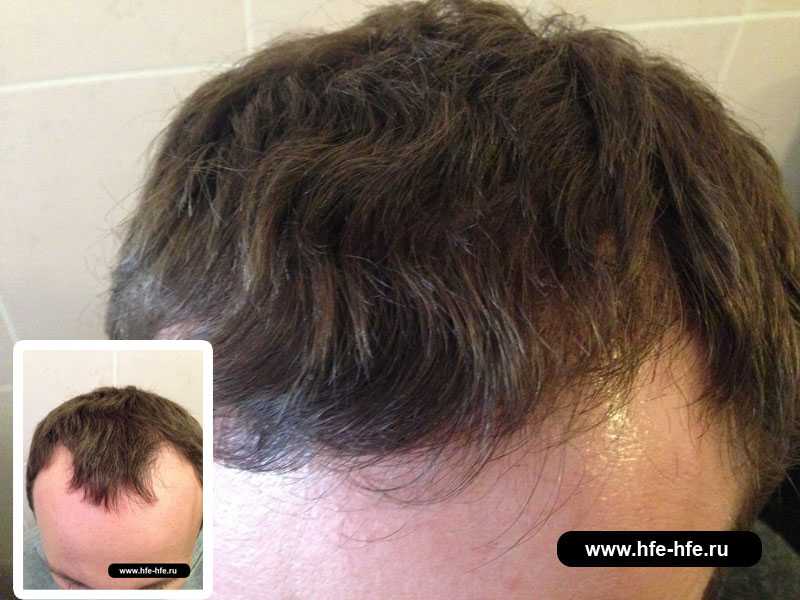 15 причин выпадения волос у мужчин - клиника «доктор волос»