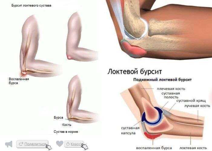 Колит при беременности – патология не очень частая, но любое заболевание во время беременности несет потенциальную угрозу будущему малышу.