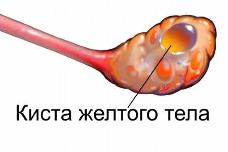 Опухоли и опухолевидные образования яичников