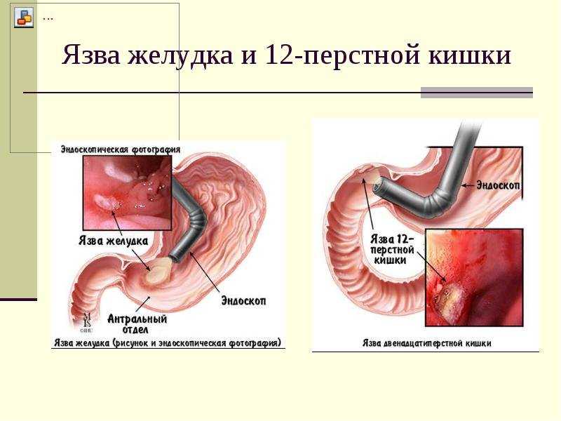 Язвенная болезнь желудка: причины заболевания, методы лечения и профилактики