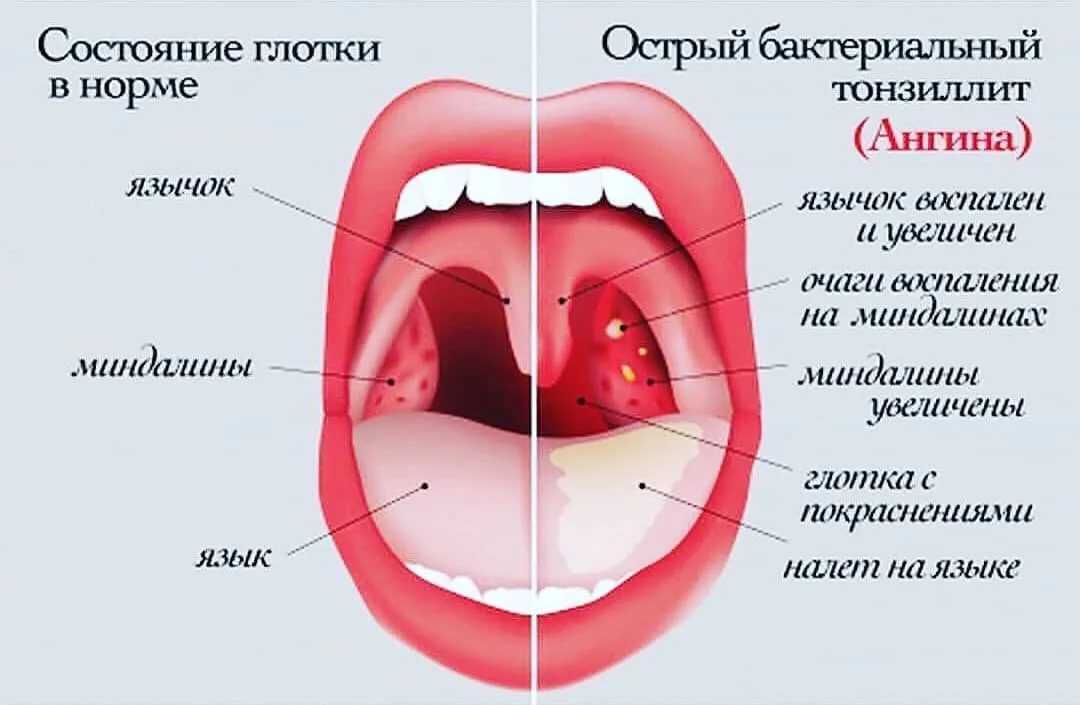 Как болит горло при коронавирусе – бывает ли, как выглядит, отличие от орви, першение