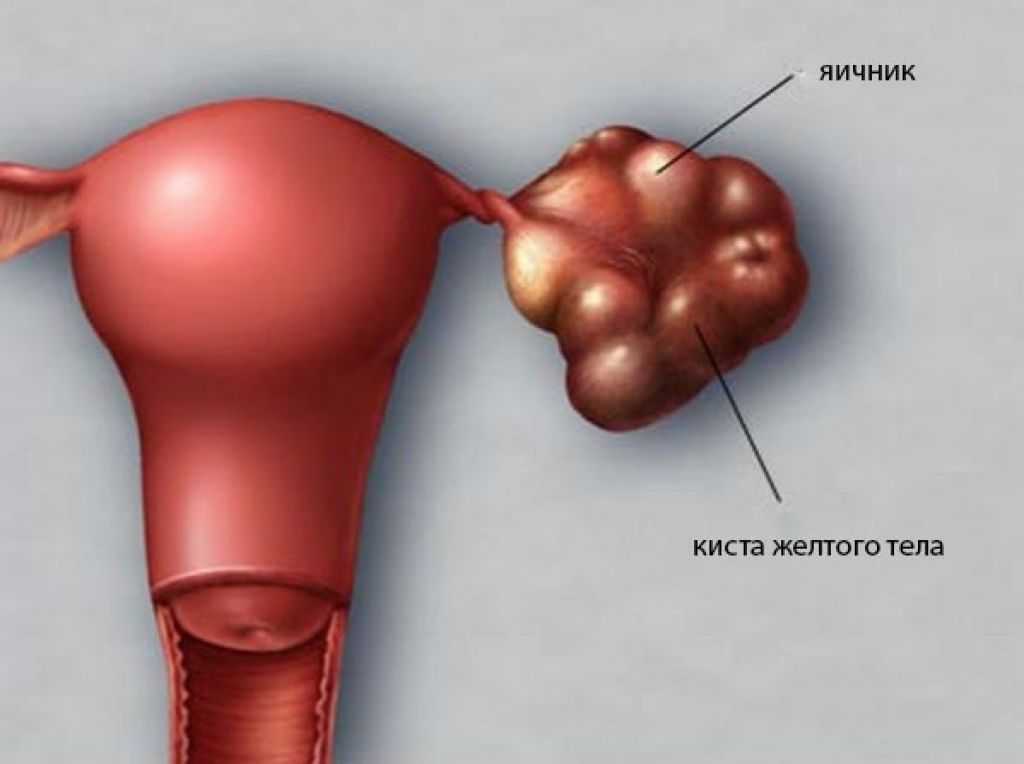 Киста или опухоль яичника — лечение в цэлт. фолликулярная и параовариальная киста
