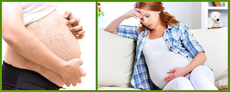 Аллергия во время беременности: причины, признаки, последствия для плода
