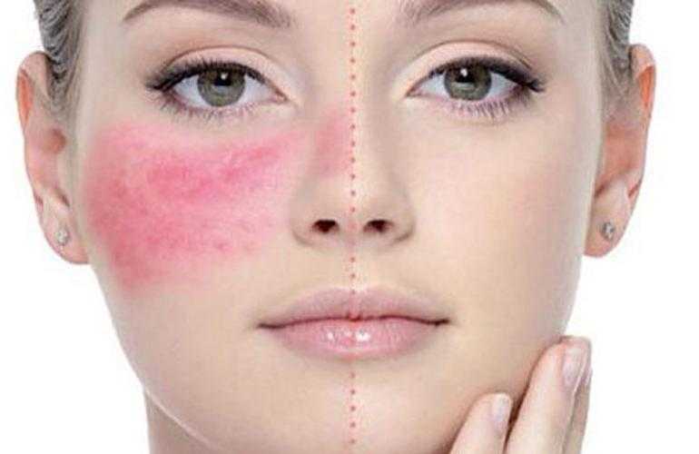 Аллергия на мейкап: как распознать и как защититься