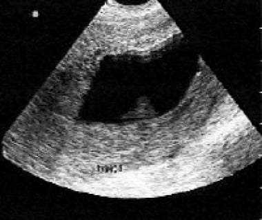 Замершая беременность на 16 неделе симптомы | первая беременность