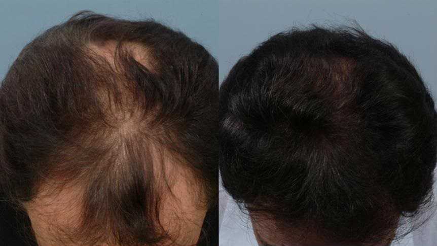 Влияет ли химическая завивка на выпадение волос?