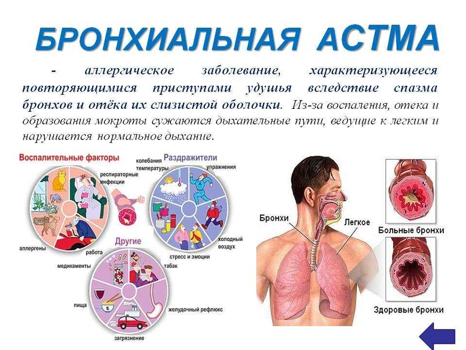 Аллергическая астма - это часто встречающийся вид астмы. Именно поэтому аллергическая астма сопровождается насморком, кашлем и сильной одышкой.