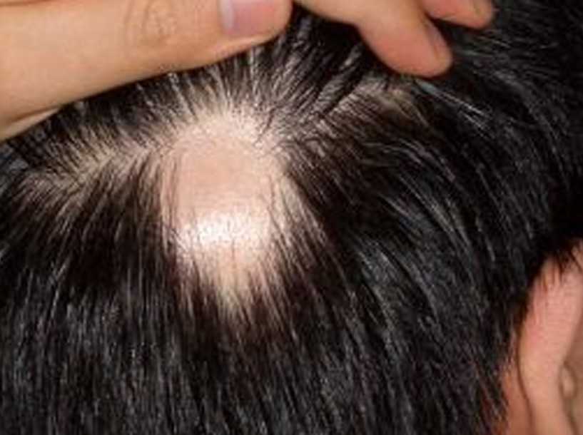 Психоэмоциональные нарушения у пациентов с выпадением волос