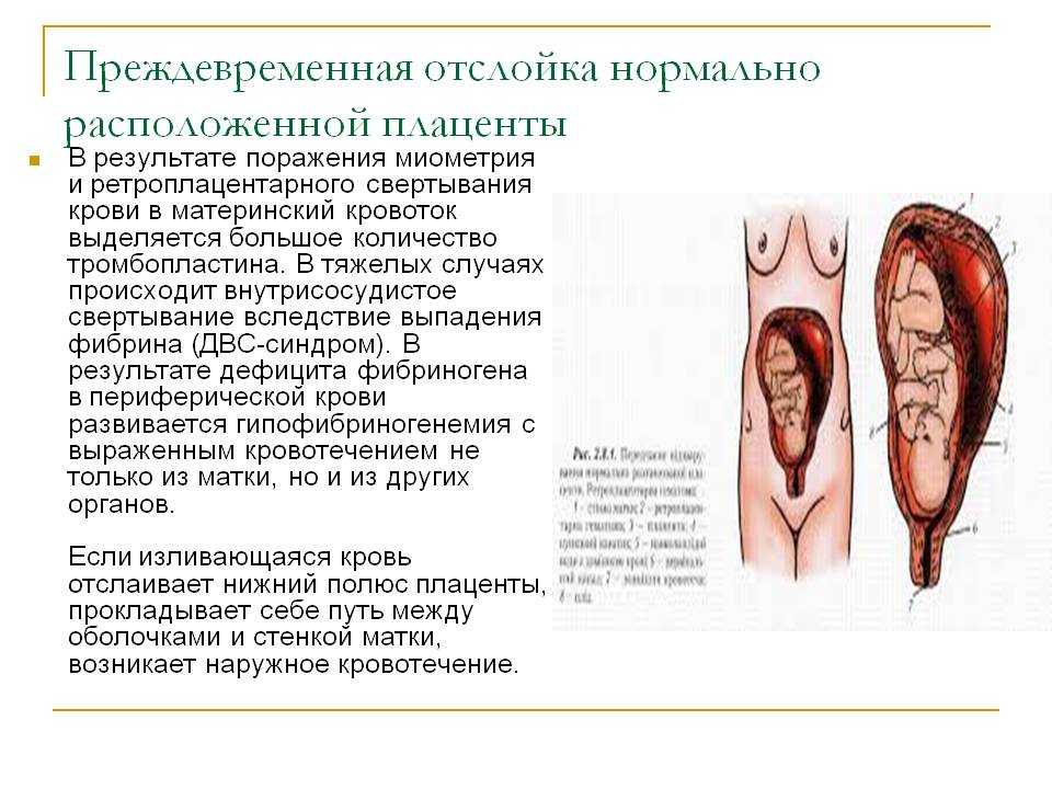 Отслойка плаценты | eurolab | гинекология