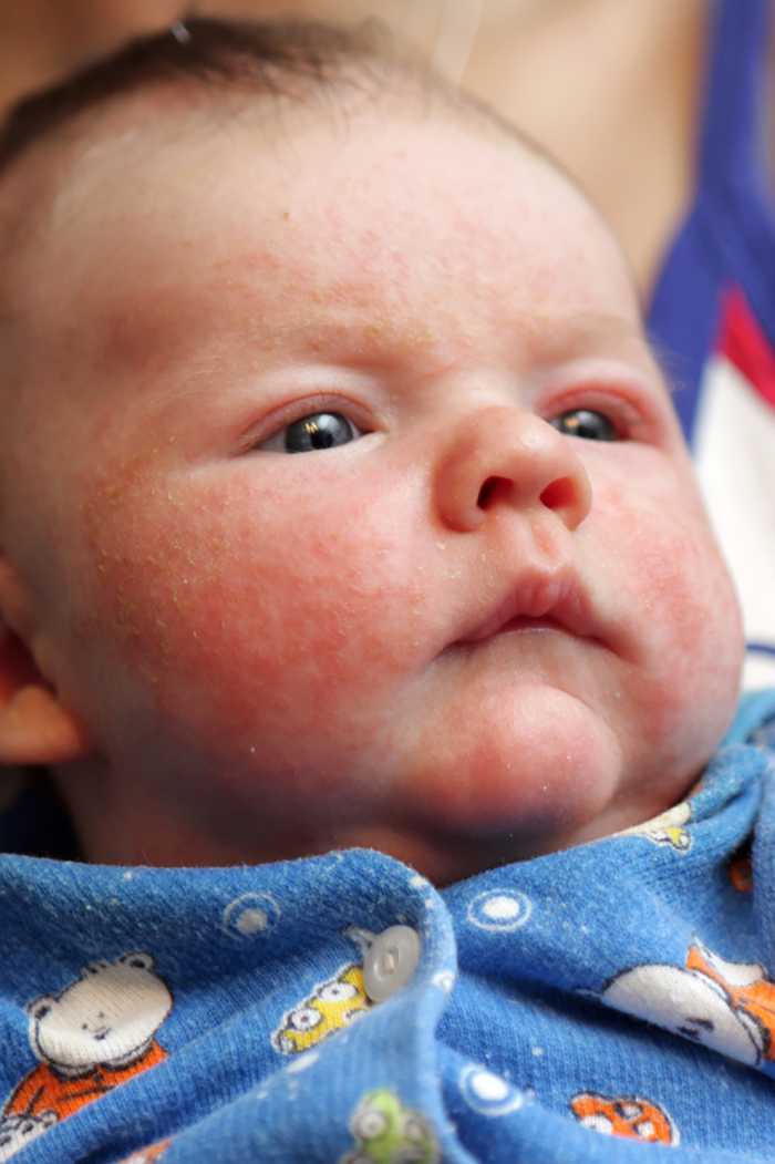 Аллергия у детей. что нужно знать? — добрый доктор