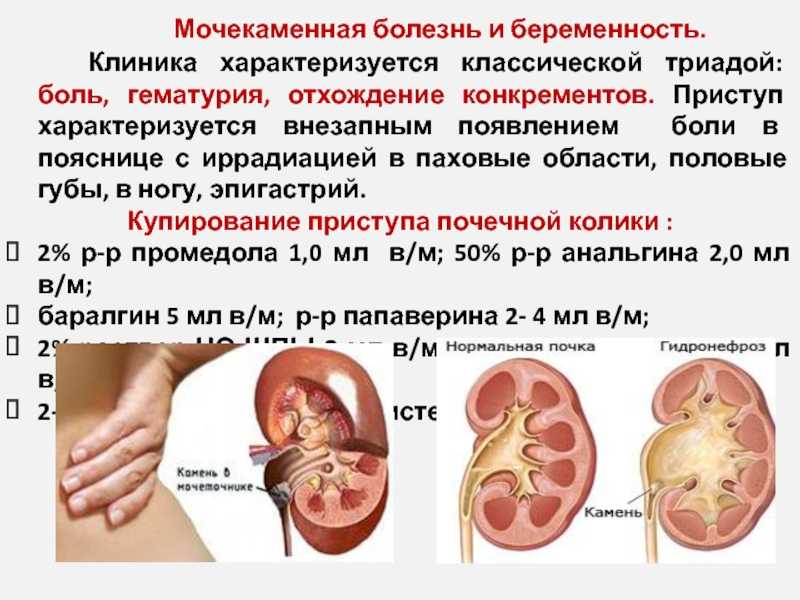 Мочекаменная болезнь почек. Мочекаменная болезнь макрогематурия. Камни в почках гематурия. Камни в почках при беременности 1 триместр. Мочекаменная болезнь причины возникновения.