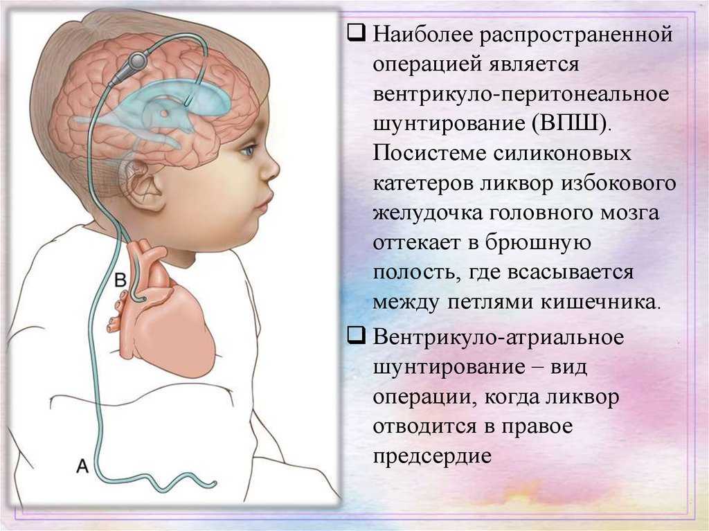 Ишемическая головного мозга новорожденного. Вентрикулоперитонеальный шунт схема. Шунт головного мозга при гидроцефалии. Шунт ВПШ вентрикуло-перитонеальный. Вентрикулярный шунт при гидроцефалии.