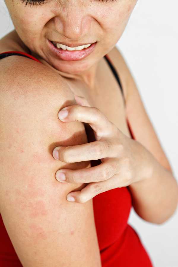 Аллергия на цитрусовые: причины, симптомы, лечение