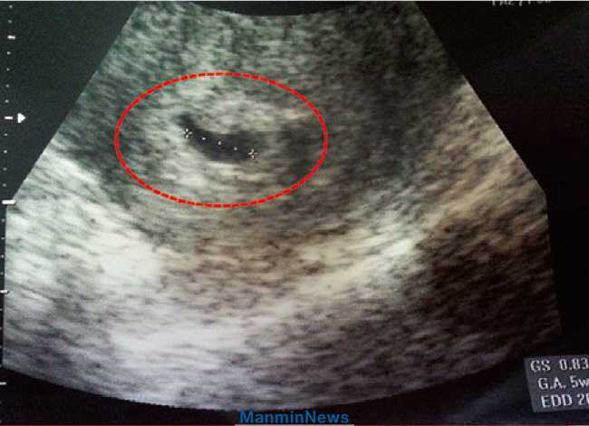 Ретрохориальная гематома при беременности на ранних сроках