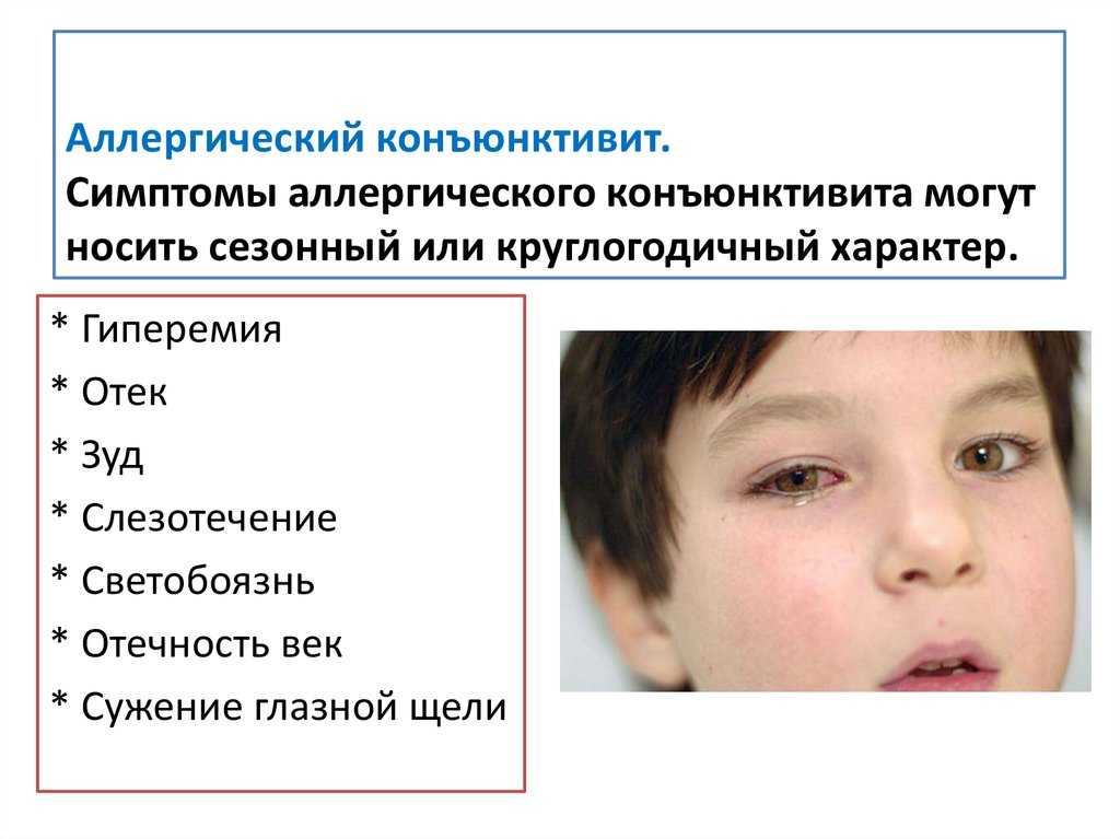 Конъюнктивит у детей: причины, признаки, лечение «ochkov.net»
