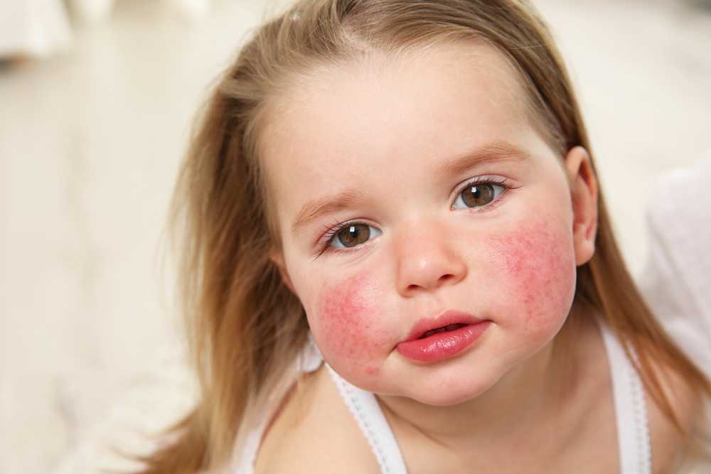 Аллергия у детей развивается по тому же механизму, что и у взрослых, да и причины ее возникновения такие же.