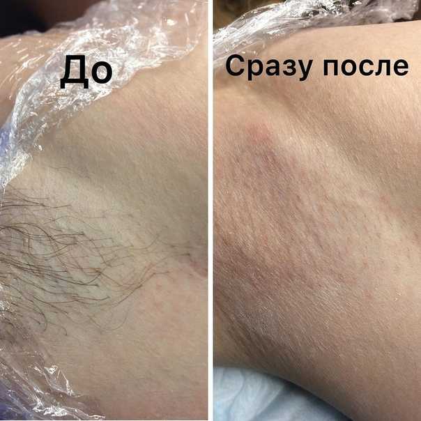 Удаление волос навсегда в домашних условиях