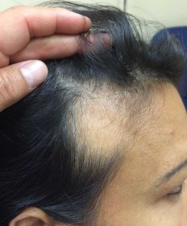 Если после окрашивания выпадают волосы, то это нормальная реакция волос на химическое воздействие.