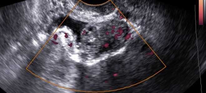 Аденомиоз матки и беременность