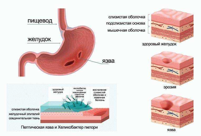 Как восстановить защитные свойства желудка при рефлюксной болезни | стимбифид плюс