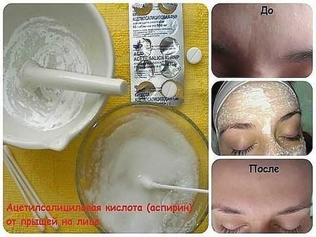 Ацетилсалициловая кислота: 18 масок для лица с аспирином в домашних условиях для кожи