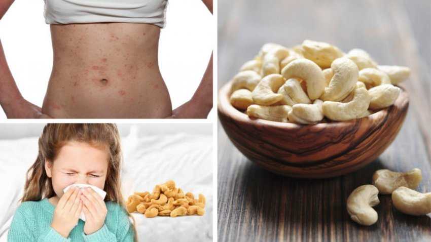 Симптомы, причины, лечение аллергии на арахис у детей и взрослых