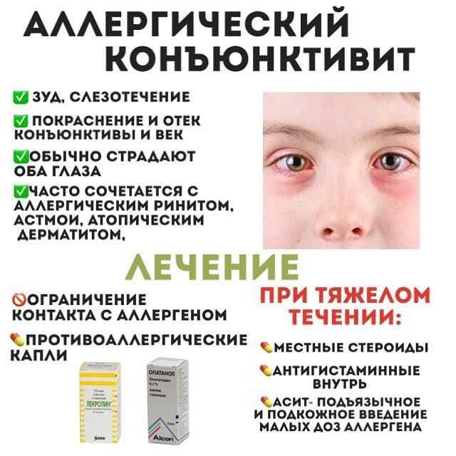 Аллергический конъюнктивит: лечение у взрослых - энциклопедия ochkov.net