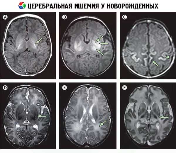 Диагностика и лечение ишемии головного мозга (александров)