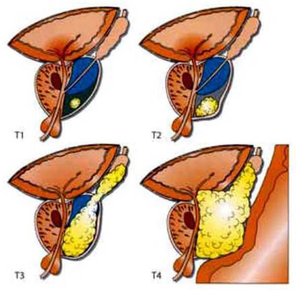 Предстательная железа рак лечится. Карцинома предстательной железы. Злокачественное новообразование предстательной железы. Опухоль предстательной железы стадии. Метастазирование предстательной железы.