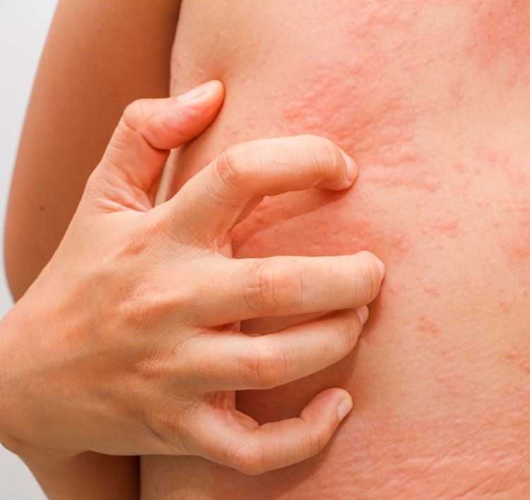 Пищевая аллергия - лечение у взрослых и детей