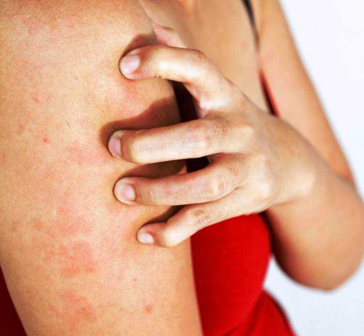 Бытовая аллергия | энтеросгель