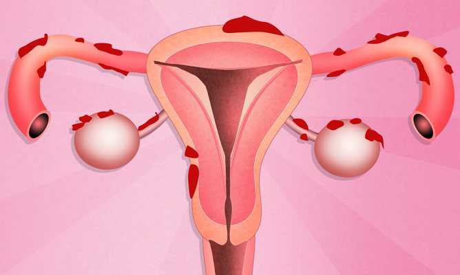 Аденомиоз матки – скрытная болезнь со сложным лечением