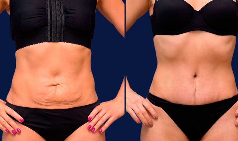Причины и лечение сосудистых звездочек на груди у женщин