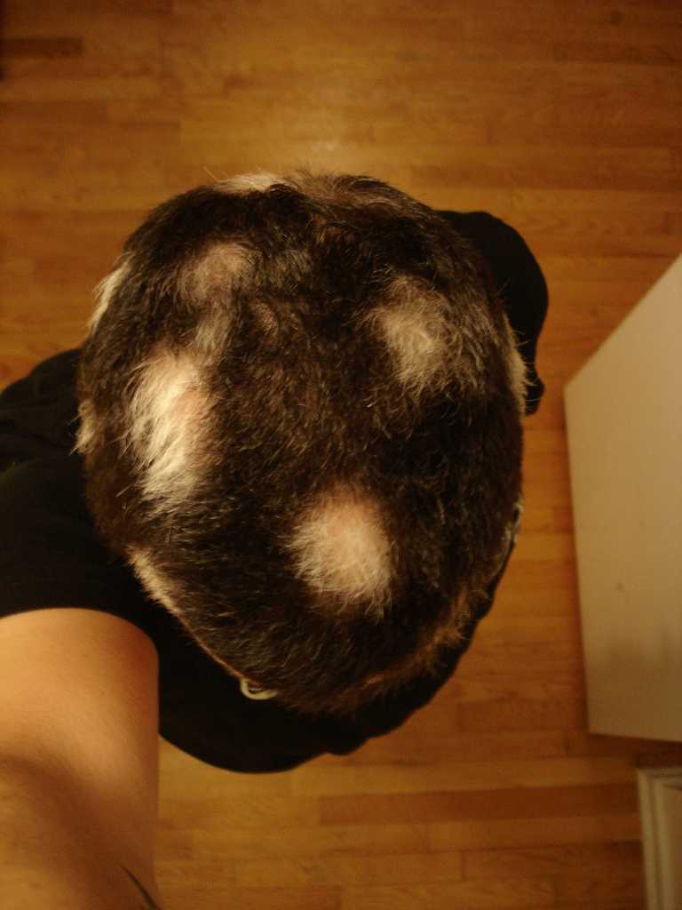 Сезонное выпадение волос: когда и почему это может происходить?