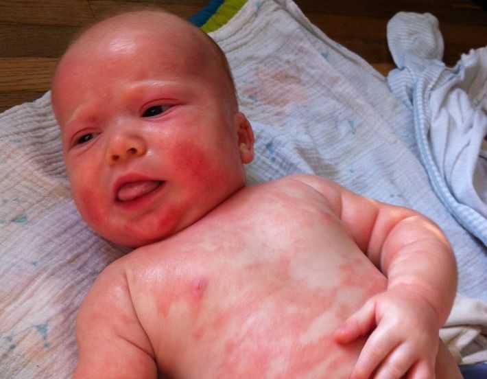 Контактная аллергия у ребенка и взрослых. причины, симптомы, лечение, профилактика - детская поликлиника маркушка