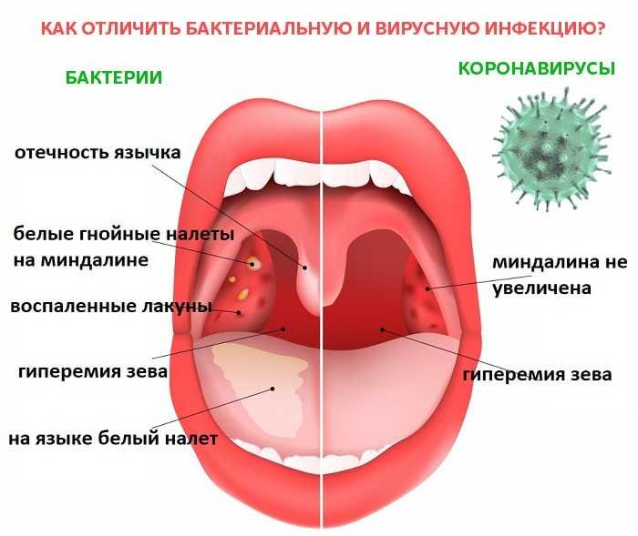 Болит горло: почему? боль в горле при температуре и без температуры. что делать, если заболело горло?